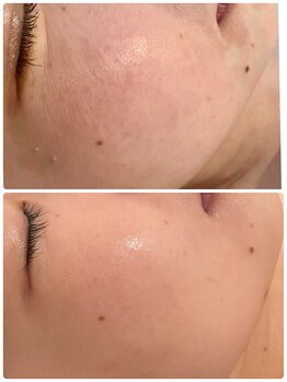 ミラ(Mila)/毛穴洗浄 BeforeAfter