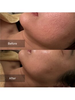 サロンドボーテ フォレッタ(Salon de beaute Folletta)/大人気ウルトラVリフト!