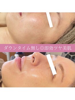 ミエル(miel)/【シミケア×ハーブピーリング】