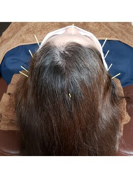 悠雲(ユウウン)/頭への鍼