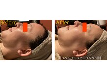 ロイヤリティ(ROYALTY)/細絡/シミ/シワ/くすみ