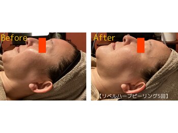 ロイヤリティ(ROYALTY)/細絡/シミ/シワ/くすみ