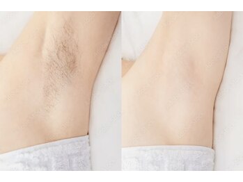 サロンミー(salon Mii)/ワキ脱毛