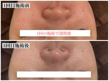 テンニック(10nick)/1回での効果が高い