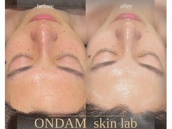 オンダム 表参道(ONDAM)/男性特有の肌悩みもお任せ