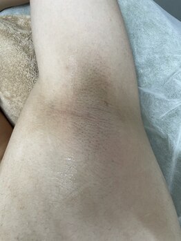 ナノハナ/鹿沼市の全身脱毛のナノハナ