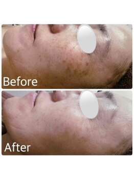 ブランシェ 高岡店 × 椿/シミケア　お客様