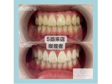 歯科提携ホワイトニング症例写真【恵比寿/ホワイトニング】