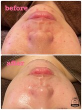 雅菜(miyabina)/しつこい肌荒れ軽減！！