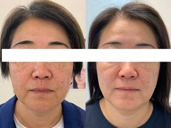 シミケア専門店 SAKURA 平塚店/平塚シミケア/伊勢店シミケア