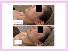 キワミビューティ(KIWAMI BEAUTY)/【WINBACK1回】顔