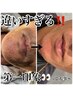 【男性】ヒゲ撲滅！痛みはあなたに合わせて調節可◎　￥7,700