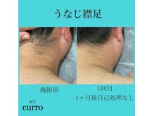 アクト クロ(ACT curro)/【うなじ襟足】脱毛施術例