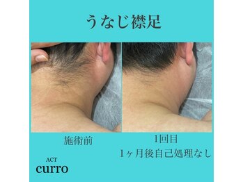アクト クロ(ACT curro)/【うなじ襟足】脱毛施術例