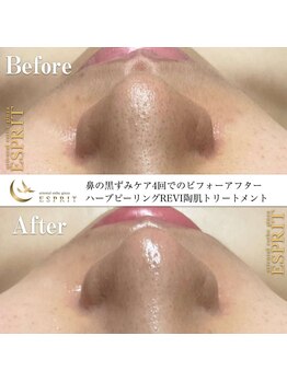 エスプリ 銀座店/ハーブピーリング銀座