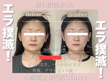 ジェイミー(Gemiey)/エラでお悩みのお客様