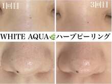 ホワイトアクア 錦糸町店(WHITE AQUA)/ハーブピーリング/東京/錦糸町