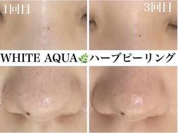 ホワイトアクア 錦糸町店(WHITE AQUA)/ハーブピーリング/東京/錦糸町