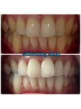 ホワイトニングショップ 大阪玉造店/Before&After美白ホワイトニング
