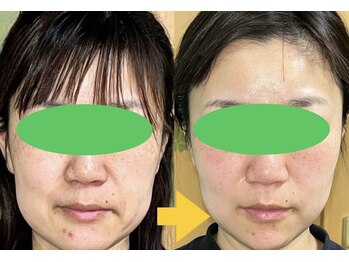 ふくふく/小顔矯正+美顔トリートメント