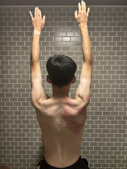 Actibo【整体・パーソナルトレーニング】/カッピングによるケア