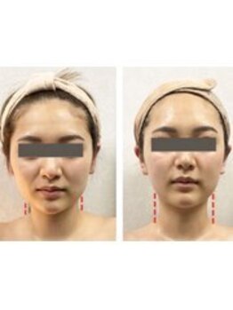 TKC 東京小顔センター五反田店の写真/短期集中で小顔に！オリジナル「小顔矯正」たるみ、ほうれい線を改善！首長小顔へ！挙式、ブライダルにも◎