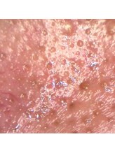 一見するとそんなにトラブルなし！？…毛穴拡大画像