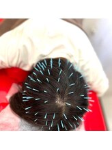 よつば鍼灸整骨院 春日院/頭皮鍼