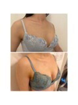 美人バスト 表参道店/【バストアップ/育乳 症例】