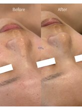 オン(on.)/《お客様症例》施術1回