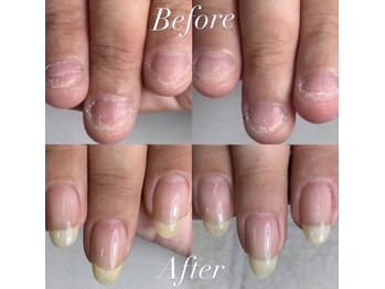 ロイヤル ネイルサロン(Royal nail Saloon)/深爪育成
