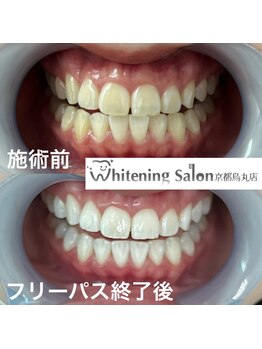 ホワイトニングサロン 京都烏丸店/ホワイトニング施術例