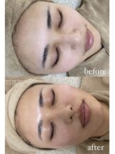 ミーミドットアイ(Mi-mi.i)/艶肌WAX脱毛＋炭酸ガスパック