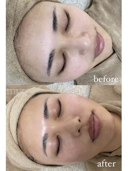 ミーミドットアイ(Mi-mi.i)/艶肌WAX脱毛+炭酸ガスパック