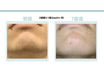 メラヴィー 上社店(meravi)/【メンズ】髭脱毛