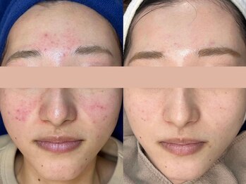 ロイ 初生店(LOI)/プラズマでニキビケア 