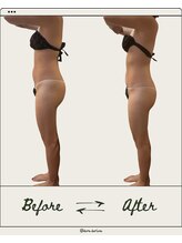 ドゥ ドルチェ(Due dolce)/前もものハリもスッキリ　1回