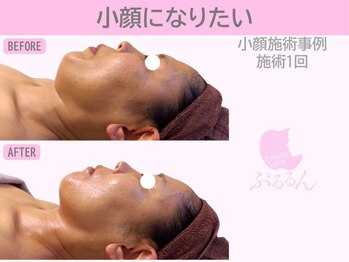 ぷるるんエステ/毛穴/小顔/フェイシャル