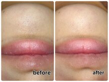 10代女性♪毛穴洗浄で密かに気になるあごのザラつきも綺麗に☆