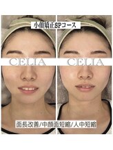 セリア(CELIA)/小顔矯正　
