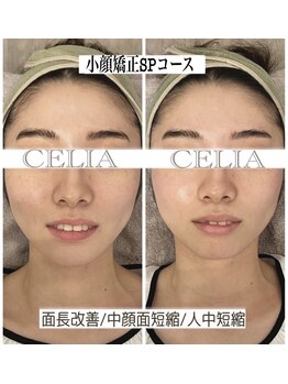 セリア(CELIA)/小顔矯正　