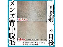 ツバキ(TSUBAKI)/メンズ背中脱毛