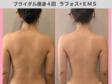 エントテ(en to Te)/ブライダル痩身◎腕背中ハミ肉