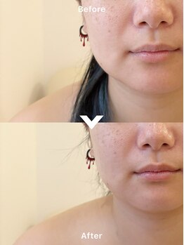 ロンルナール(Rond Renard)/