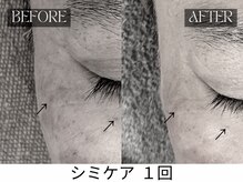 スキンジム(SKIN GYM)/シミが薄くなると表情も明るく◎