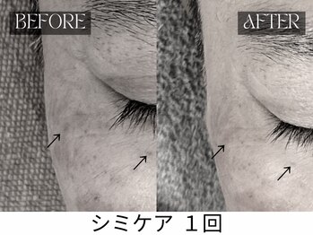 スキンジム(SKIN GYM)/シミが薄くなると表情も明るく◎