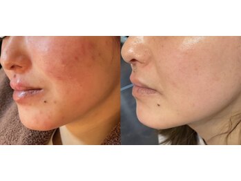 マナ(mana)/肌荒れにも！肌強化☆