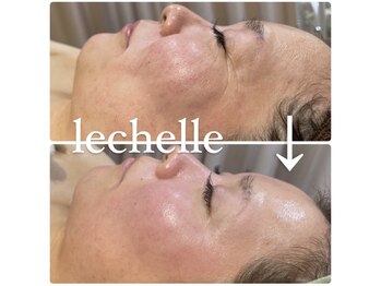 レシェルサロン(Lechelle Salon)/ハーブピーリング