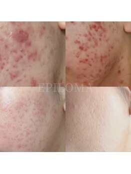 エピロマ(EPILOMA)/鹿児島市/宇宿/ニキビケア