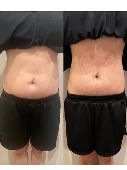 長寿鍼灸院 長寿整骨院/EMS<お腹集中コース>